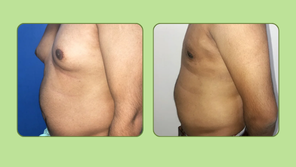 Gynecomastia result